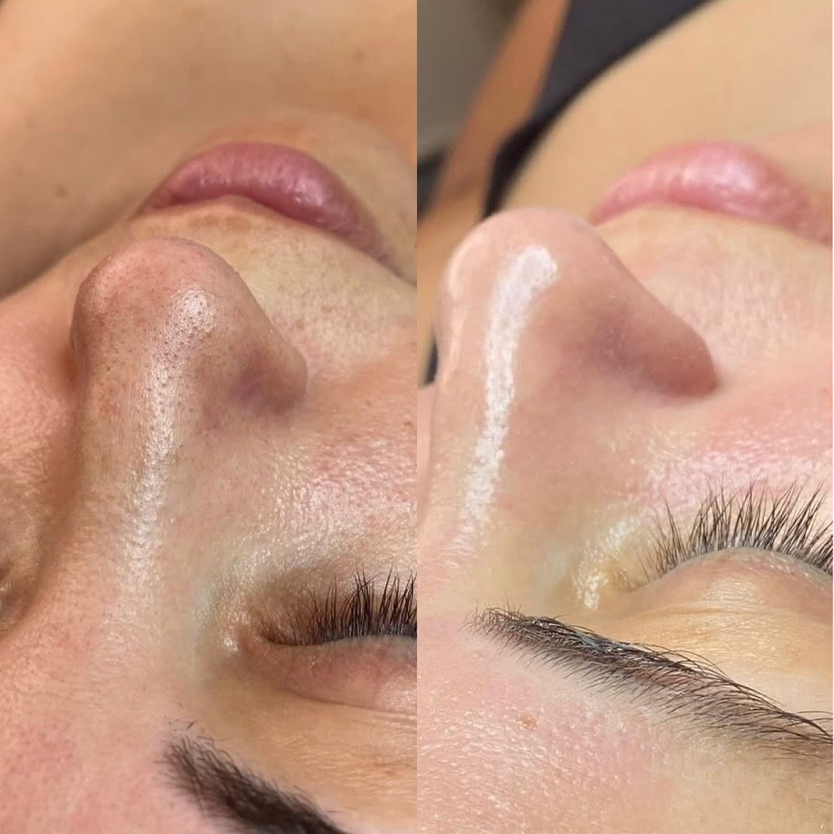 Hydrafacial Behandlungen