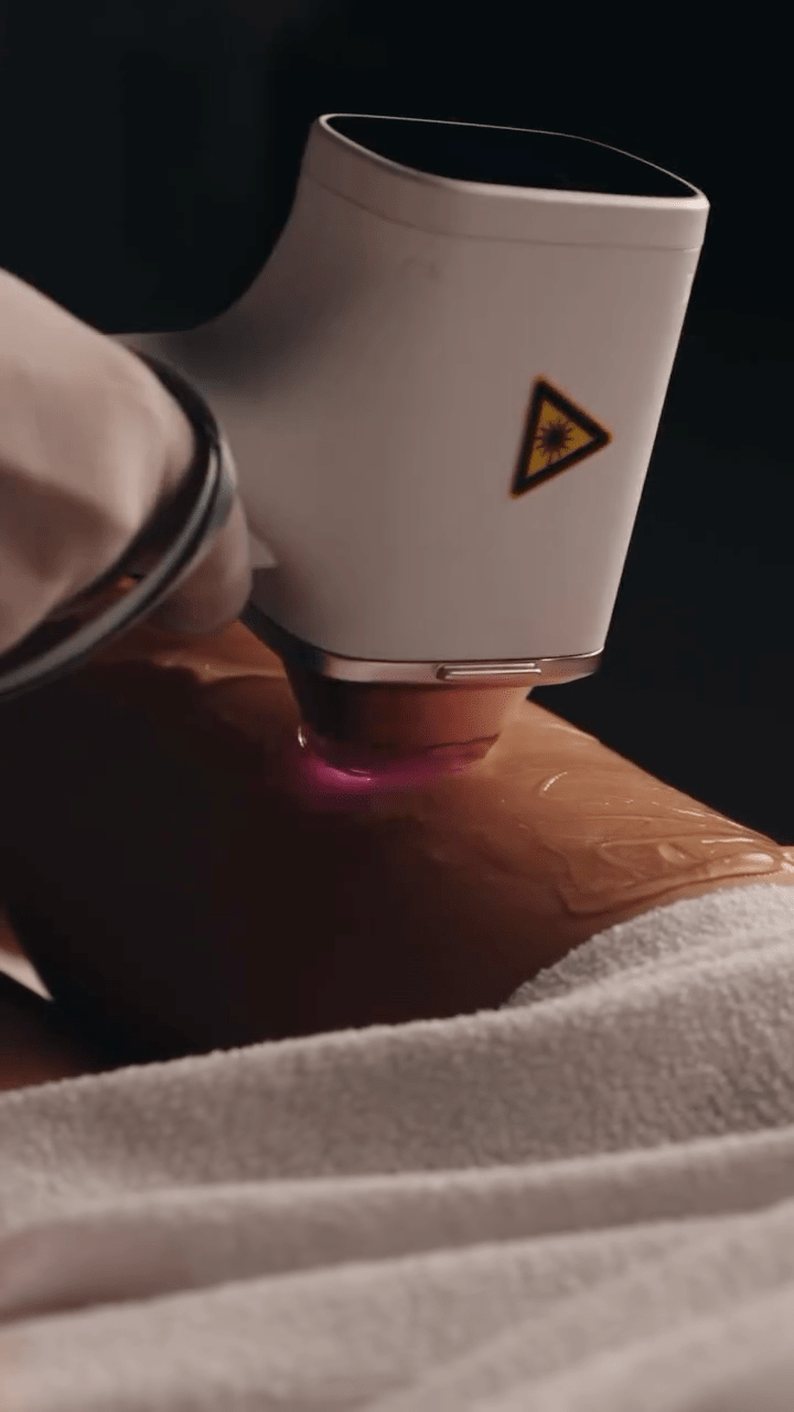 Handstück für die Laser-Haarentfernung